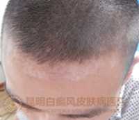 额头白癜风,在我院成功治愈