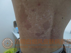17岁男生背部大面积白斑,在我院治愈
