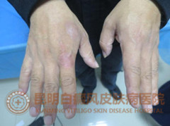 手部白斑1年,在我院成功治愈