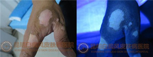 手部白斑1年,在我院成功治愈