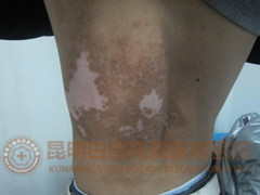 17岁男生背部大面积白斑,在我院治愈