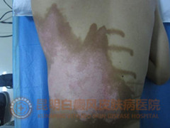 17岁男生背部大面积白斑,在我院治愈