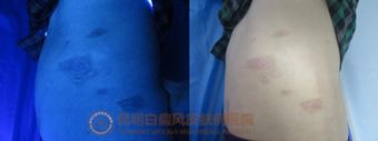 腹部白斑2个月,在我院成功治愈