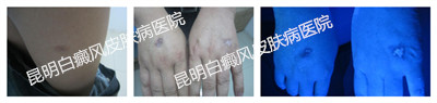 男性腿部、双手白斑多年,在我院成功治愈