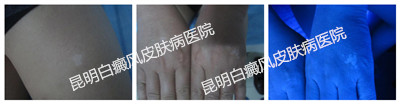 男性腿部、双手白斑多年,在我院成功治愈