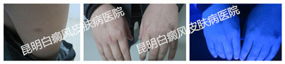 男性腿部、双手白斑多年,在我院成功治愈
