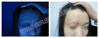 24岁女性,右额头眉弓白斑10年,在我院成功治愈