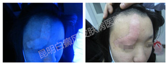24岁女性,右额头眉弓白斑10年,在我院成功治愈