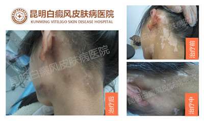 白癜风对青少年和儿童的危害最大