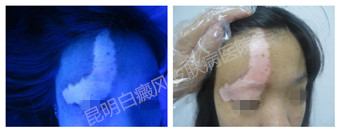 24岁女性,右额头眉弓白斑10年,在我院成功治愈
