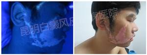 面部大面积白斑三年,在我院成功治愈