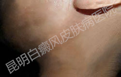 突发白斑,找工作屡次被拒