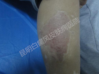 白斑消失了,开心迎接大学新生活