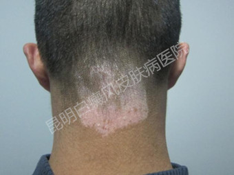 告别白斑,重拾青少年的的阳光