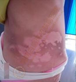 身患白癜风数十载,在我院成功治愈