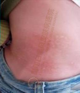 身患白癜风数十载,在我院成功治愈