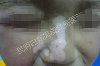 儿子脸上大块白斑 未来之路受阻