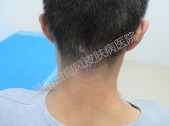 告别白斑,重拾青少年的的阳光