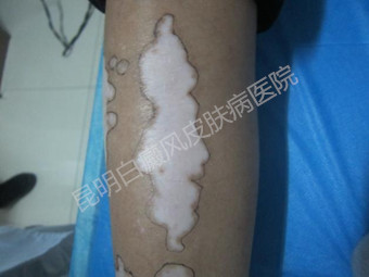 白斑消失了,开心迎接大学新生活