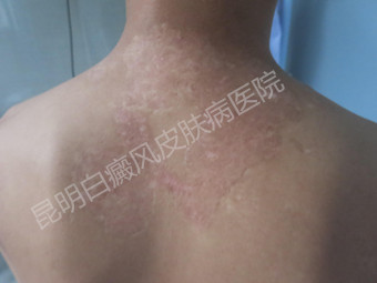 大学生2年的白癜风在我院3个月治好