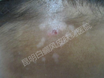 18岁女孩额头白斑,在我院康复