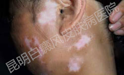 突发白斑,找工作屡次被拒