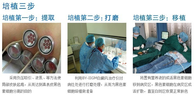 黑色素细胞培植术