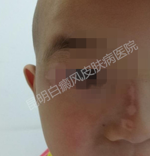 儿子脸上大块白斑 未来之路受阻