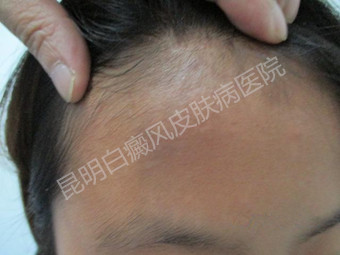 18岁女孩额头白斑,在我院康复